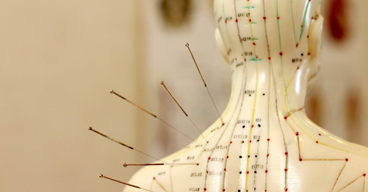 Acupuncture Singapore